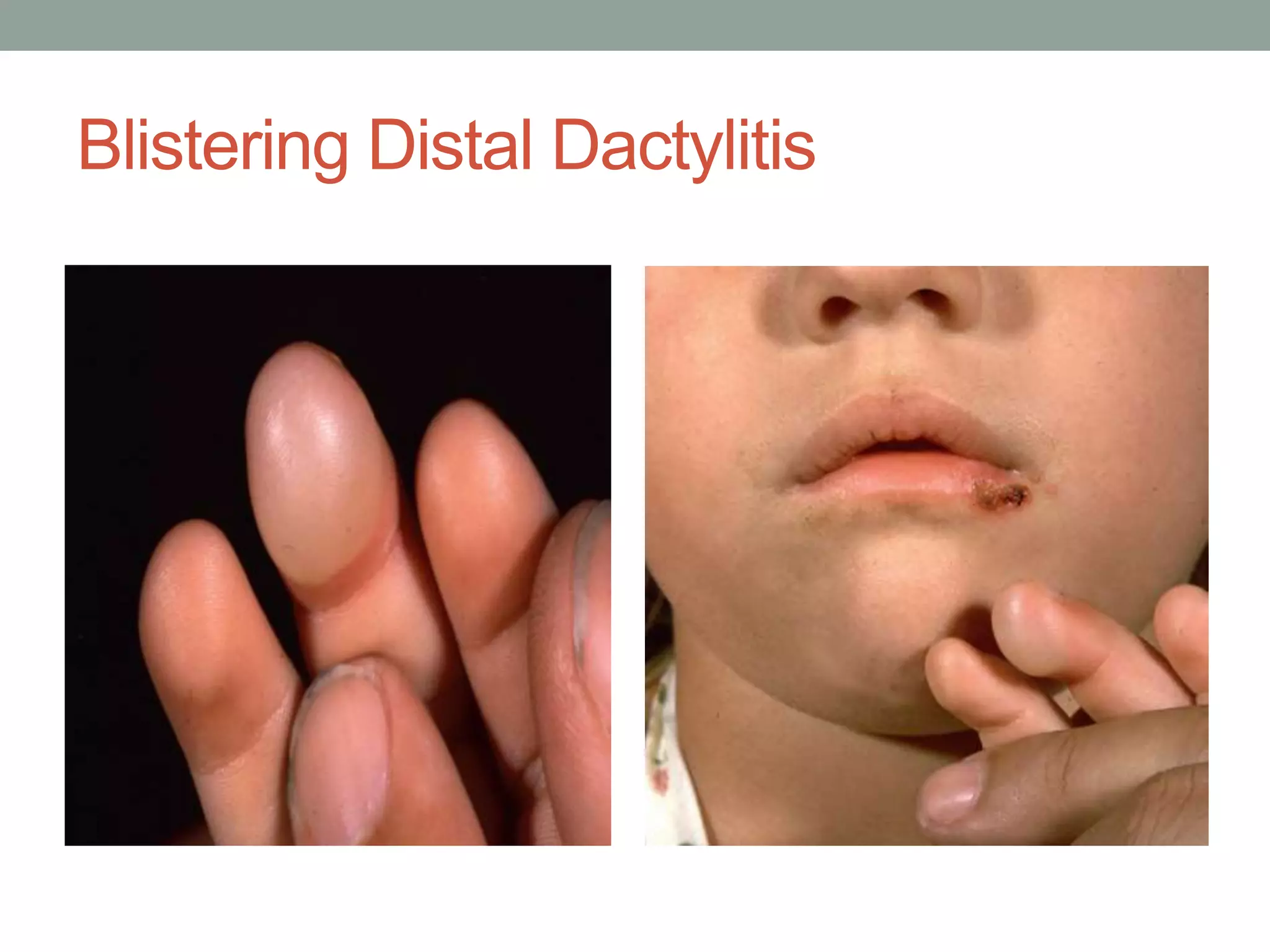 Bullous skin diseases | PPTX