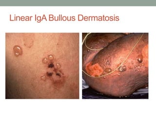 Linear IgA Bullous Dermatosis
 