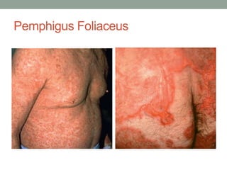 Pemphigus Foliaceus
 