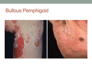 Bullous Pemphigoid
 