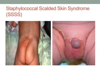 Staphylococcal Scalded Skin Syndrome
(SSSS)
 