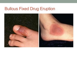 Bullous Fixed Drug Eruption
 