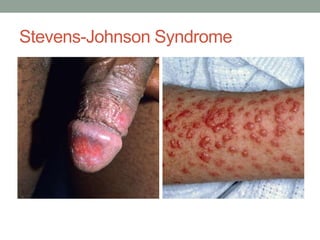 Stevens-Johnson Syndrome
 
