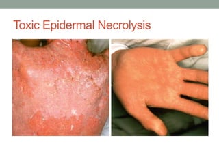 Toxic Epidermal Necrolysis
 