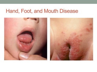 Hand, Foot, and Mouth Disease
•
.
 