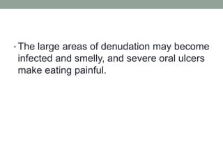 • The large areas of denudation may become
infected and smelly, and severe oral ulcers
make eating painful.
 