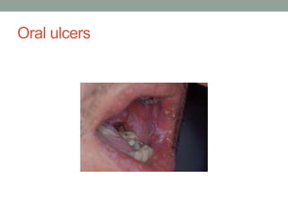 Oral ulcers
 