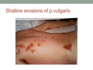 Shallow erosions of p.vulgaris
 