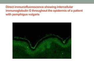Direct immunofluorescence showing intercellular
immunoglobulin G throughout the epidermis of a patient
with pemphigus vulgaris
 