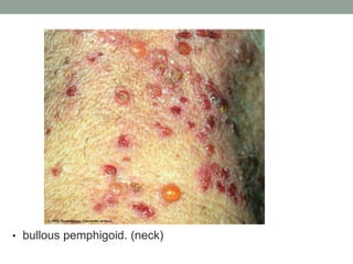 • bullous pemphigoid. (neck)
 
