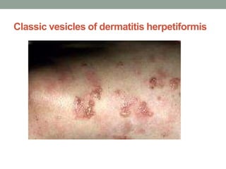 Classic vesicles of dermatitis herpetiformis
 