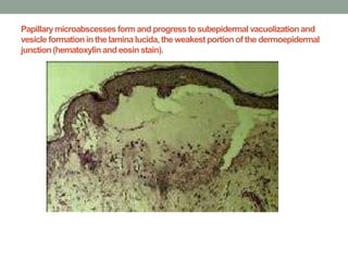 Papillarymicroabscesses form and progress to subepidermalvacuolization and
vesicle formationin the lamina lucida,the weakestportionof the dermoepidermal
junction(hematoxylinand eosin stain).
 