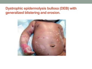Dystrophic epidermolysis bullosa (DEB) with
generalized blistering and erosion.
 