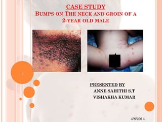 CASE STUDY
BUMPS ON THE NECK AND GROIN OF A
2-YEAR OLD MALE
PRESENTED BY
ANNE SAHITHI S.T
VISHAKHA KUMAR
4/8/2014
1
 
