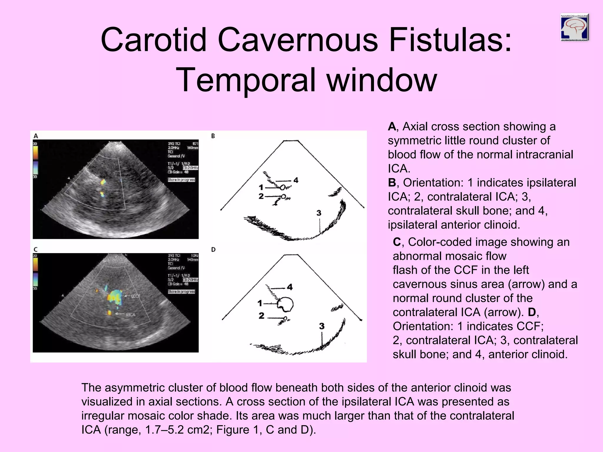 Carotid Cavernous Fistulas:
Temporal window
A, Axial cross section showing a
symmetric little round cluster of
blood flow of the normal intracranial
ICA.
B, Orientation: 1 indicates ipsilateral
ICA; 2, contralateral ICA; 3,
contralateral skull bone; and 4,
ipsilateral anterior clinoid.
C, Color-coded image showing an
abnormal mosaic flow
flash of the CCF in the left
cavernous sinus area (arrow) and a
normal round cluster of the
contralateral ICA (arrow). D,
Orientation: 1 indicates CCF;
2, contralateral ICA; 3, contralateral
skull bone; and 4, anterior clinoid.
The asymmetric cluster of blood flow beneath both sides of the anterior clinoid was
visualized in axial sections. A cross section of the ipsilateral ICA was presented as
irregular mosaic color shade. Its area was much larger than that of the contralateral
ICA (range, 1.7–5.2 cm2; Figure 1, C and D).
 