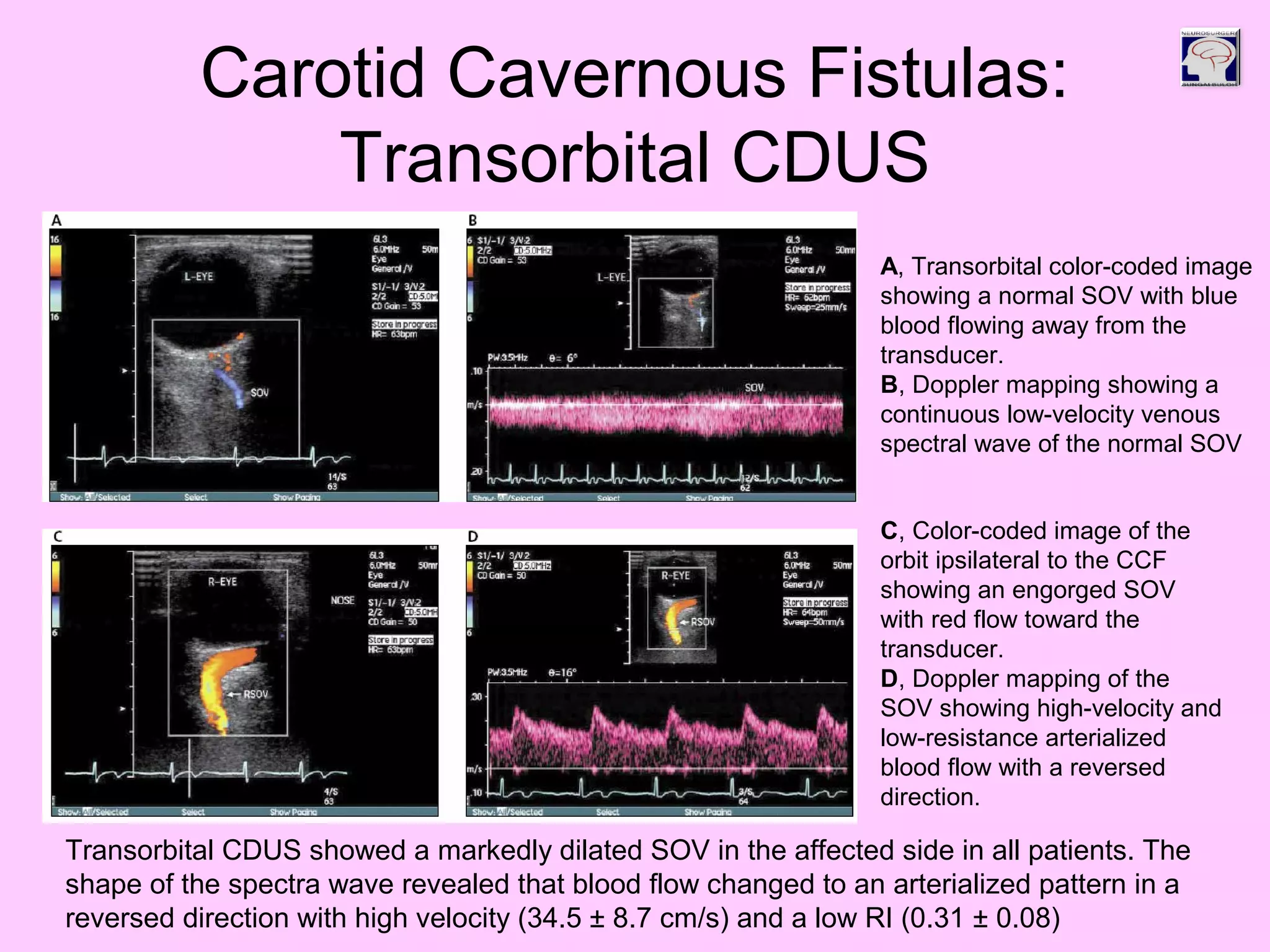 Carotid Cavernous Fistulas:
Transorbital CDUS
A, Transorbital color-coded image
showing a normal SOV with blue
blood flowing away from the
transducer.
B, Doppler mapping showing a
continuous low-velocity venous
spectral wave of the normal SOV
C, Color-coded image of the
orbit ipsilateral to the CCF
showing an engorged SOV
with red flow toward the
transducer.
D, Doppler mapping of the
SOV showing high-velocity and
low-resistance arterialized
blood flow with a reversed
direction.
Transorbital CDUS showed a markedly dilated SOV in the affected side in all patients. The
shape of the spectra wave revealed that blood flow changed to an arterialized pattern in a
reversed direction with high velocity (34.5 ± 8.7 cm/s) and a low RI (0.31 ± 0.08)
 