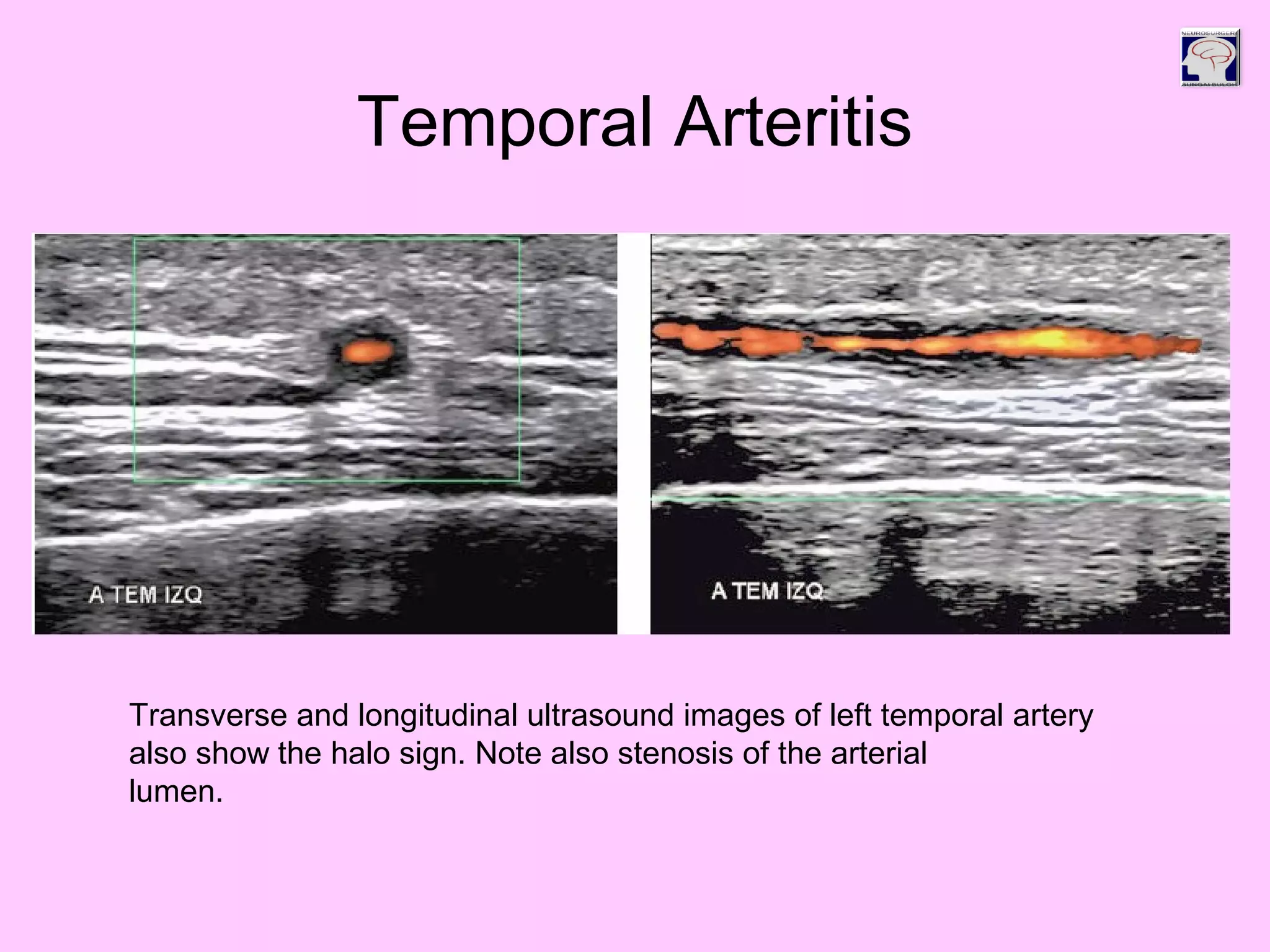 Temporal Arteritis
Transverse and longitudinal ultrasound images of left temporal artery
also show the halo sign. Note also stenosis of the arterial
lumen.
 
