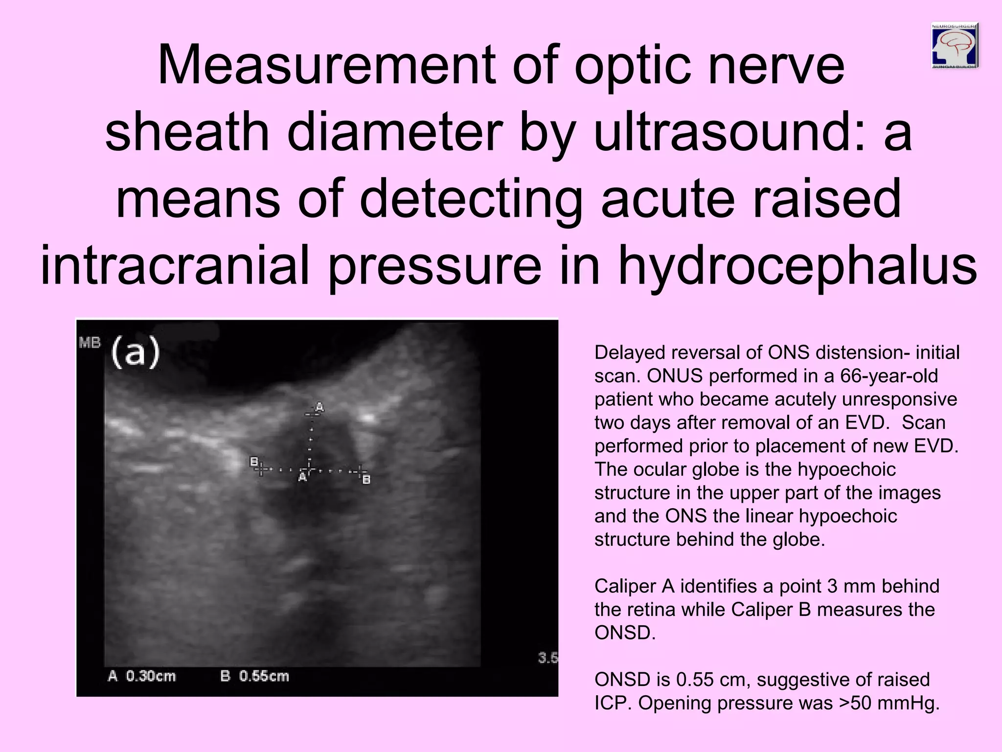 Delayed reversal of ONS distension- initial
scan. ONUS performed in a 66-year-old
patient who became acutely unresponsive
two days after removal of an EVD. Scan
performed prior to placement of new EVD.
The ocular globe is the hypoechoic
structure in the upper part of the images
and the ONS the linear hypoechoic
structure behind the globe.
Caliper A identifies a point 3 mm behind
the retina while Caliper B measures the
ONSD.
ONSD is 0.55 cm, suggestive of raised
ICP. Opening pressure was >50 mmHg.
Measurement of optic nerve
sheath diameter by ultrasound: a
means of detecting acute raised
intracranial pressure in hydrocephalus
 