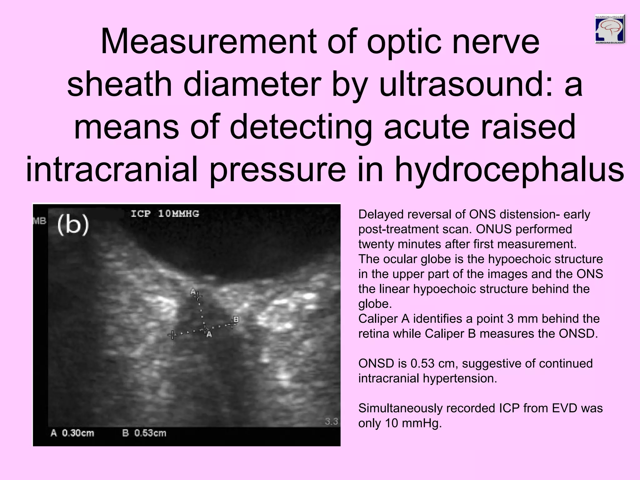 Delayed reversal of ONS distension- early
post-treatment scan. ONUS performed
twenty minutes after first measurement.
The ocular globe is the hypoechoic structure
in the upper part of the images and the ONS
the linear hypoechoic structure behind the
globe.
Caliper A identifies a point 3 mm behind the
retina while Caliper B measures the ONSD.
ONSD is 0.53 cm, suggestive of continued
intracranial hypertension.
Simultaneously recorded ICP from EVD was
only 10 mmHg.
Measurement of optic nerve
sheath diameter by ultrasound: a
means of detecting acute raised
intracranial pressure in hydrocephalus
 