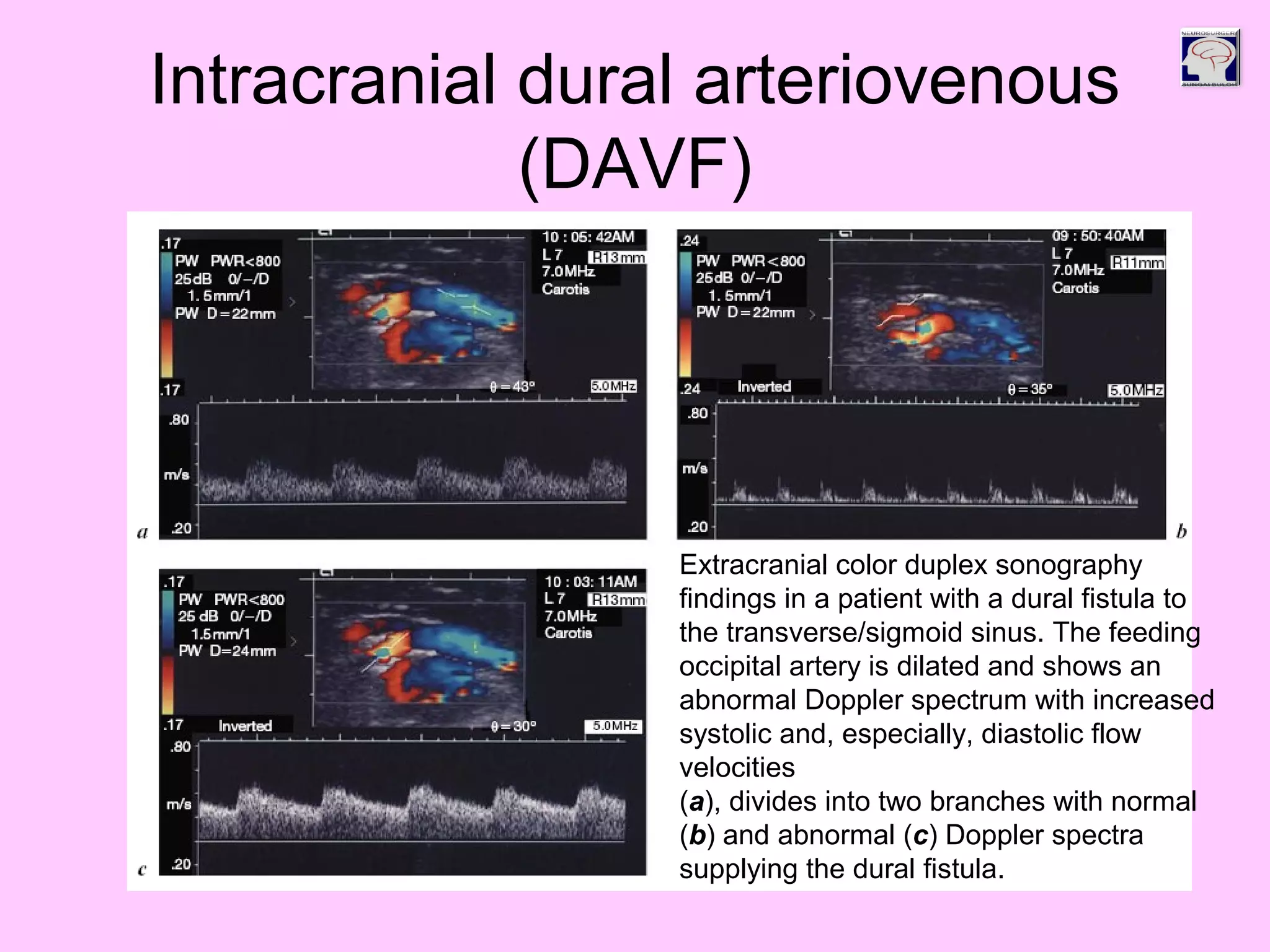 Intracranial dural arteriovenous
(DAVF)
Extracranial color duplex sonography
findings in a patient with a dural fistula to
the transverse/sigmoid sinus. The feeding
occipital artery is dilated and shows an
abnormal Doppler spectrum with increased
systolic and, especially, diastolic flow
velocities
(a), divides into two branches with normal
(b) and abnormal (c) Doppler spectra
supplying the dural fistula.
 