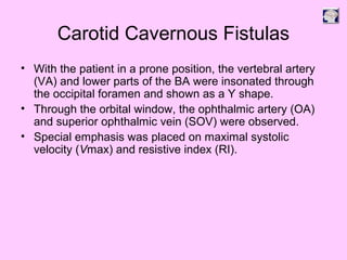 Carotid Cavernous Fistulas
• With the patient in a prone position, the vertebral artery
(VA) and lower parts of the BA were insonated through
the occipital foramen and shown as a Y shape.
• Through the orbital window, the ophthalmic artery (OA)
and superior ophthalmic vein (SOV) were observed.
• Special emphasis was placed on maximal systolic
velocity (Vmax) and resistive index (RI).
 
