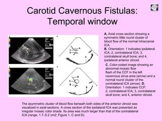 Carotid Cavernous Fistulas:
Temporal window
A, Axial cross section showing a
symmetric little round cluster of
blood flow of the normal intracranial
ICA.
B, Orientation: 1 indicates ipsilateral
ICA; 2, contralateral ICA; 3,
contralateral skull bone; and 4,
ipsilateral anterior clinoid.
C, Color-coded image showing an
abnormal mosaic flow
flash of the CCF in the left
cavernous sinus area (arrow) and a
normal round cluster of the
contralateral ICA (arrow). D,
Orientation: 1 indicates CCF;
2, contralateral ICA; 3, contralateral
skull bone; and 4, anterior clinoid.
The asymmetric cluster of blood flow beneath both sides of the anterior clinoid was
visualized in axial sections. A cross section of the ipsilateral ICA was presented as
irregular mosaic color shade. Its area was much larger than that of the contralateral
ICA (range, 1.7–5.2 cm2; Figure 1, C and D).
 