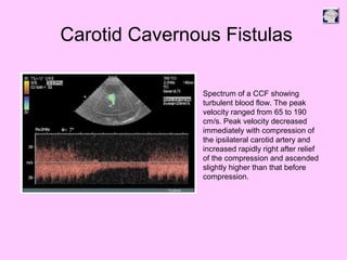 Carotid Cavernous Fistulas
Spectrum of a CCF showing
turbulent blood flow. The peak
velocity ranged from 65 to 190
cm/s. Peak velocity decreased
immediately with compression of
the ipsilateral carotid artery and
increased rapidly right after relief
of the compression and ascended
slightly higher than that before
compression.
 
