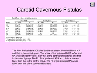 The RI of the ipsilateral ICA was lower than that of the contralateral ICA
and that in the control group. The Vmax of the ipsilateral MCA, ACA, and
OA was significantly lower than that of the contralateral arteries and that
in the control group. The RI of the ipsilateral ACA and bilateral VA was
lower than that in the control group. The RI of the ipsilateral PCA was
lower than that of the contralateral artery.
Carotid Cavernous Fistulas
 