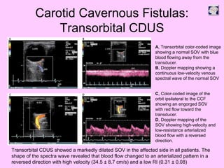Carotid Cavernous Fistulas:
Transorbital CDUS
A, Transorbital color-coded image
showing a normal SOV with blue
blood flowing away from the
transducer.
B, Doppler mapping showing a
continuous low-velocity venous
spectral wave of the normal SOV
C, Color-coded image of the
orbit ipsilateral to the CCF
showing an engorged SOV
with red flow toward the
transducer.
D, Doppler mapping of the
SOV showing high-velocity and
low-resistance arterialized
blood flow with a reversed
direction.
Transorbital CDUS showed a markedly dilated SOV in the affected side in all patients. The
shape of the spectra wave revealed that blood flow changed to an arterialized pattern in a
reversed direction with high velocity (34.5 ± 8.7 cm/s) and a low RI (0.31 ± 0.08)
 
