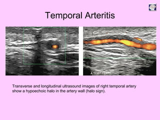 Temporal Arteritis
Transverse and longitudinal ultrasound images of right temporal artery
show a hypoechoic halo in the artery wall (halo sign).
 