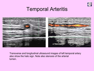 Temporal Arteritis
Transverse and longitudinal ultrasound images of left temporal artery
also show the halo sign. Note also stenosis of the arterial
lumen.
 