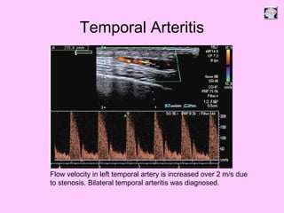 Temporal Arteritis
Flow velocity in left temporal artery is increased over 2 m/s due
to stenosis. Bilateral temporal arteritis was diagnosed.
 