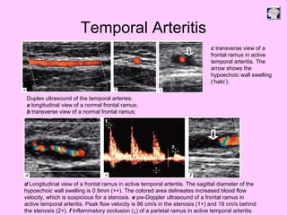 Temporal Arteritis
Duplex ultrasound of the temporal arteries:
a longitudinal view of a normal frontal ramus;
b transverse view of a normal frontal ramus;
c transverse view of a
frontal ramus in active
temporal arteritis. The
arrow shows the
hypoechoic wall swelling
(‘halo’).
d Longitudinal view of a frontal ramus in active temporal arteritis. The sagittal diameter of the
hypoechoic wall swelling is 0.9mm (++). The colored area delineates increased blood flow
velocity, which is suspicious for a stenosis. e pw-Doppler ultrasound of a frontal ramus in
active temporal arteritis. Peak flow velocity is 86 cm/s in the stenosis (1+) and 19 cm/s behind
the stenosis (2+). f Inflammatory occlusion (↓) of a parietal ramus in active temporal arteritis.
 