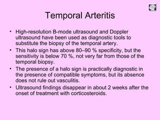 Temporal Arteritis
• High-resolution B-mode ultrasound and Doppler
ultrasound have been used as diagnostic tools to
substitute the biopsy of the temporal artery.
• This halo sign has above 80–90 % specificity, but the
sensitivity is below 70 %, not very far from those of the
temporal biopsy.
• The presence of a halo sign is practically diagnostic in
the presence of compatible symptoms, but its absence
does not rule out vasculitis.
• Ultrasound findings disappear in about 2 weeks after the
onset of treatment with corticosteroids.
 