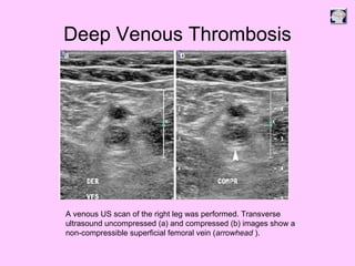 Deep Venous Thrombosis
A venous US scan of the right leg was performed. Transverse
ultrasound uncompressed (a) and compressed (b) images show a
non-compressible superficial femoral vein (arrowhead ).
 