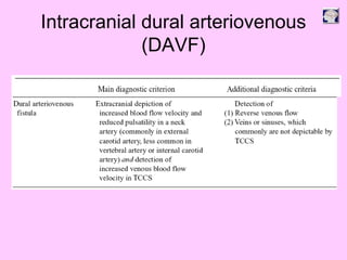 Intracranial dural arteriovenous
(DAVF)
 