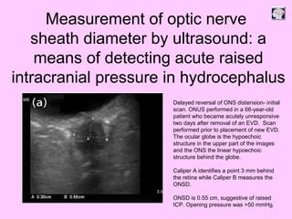 Delayed reversal of ONS distension- initial
scan. ONUS performed in a 66-year-old
patient who became acutely unresponsive
two days after removal of an EVD. Scan
performed prior to placement of new EVD.
The ocular globe is the hypoechoic
structure in the upper part of the images
and the ONS the linear hypoechoic
structure behind the globe.
Caliper A identifies a point 3 mm behind
the retina while Caliper B measures the
ONSD.
ONSD is 0.55 cm, suggestive of raised
ICP. Opening pressure was >50 mmHg.
Measurement of optic nerve
sheath diameter by ultrasound: a
means of detecting acute raised
intracranial pressure in hydrocephalus
 