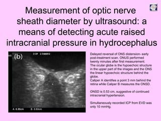 Delayed reversal of ONS distension- early
post-treatment scan. ONUS performed
twenty minutes after first measurement.
The ocular globe is the hypoechoic structure
in the upper part of the images and the ONS
the linear hypoechoic structure behind the
globe.
Caliper A identifies a point 3 mm behind the
retina while Caliper B measures the ONSD.
ONSD is 0.53 cm, suggestive of continued
intracranial hypertension.
Simultaneously recorded ICP from EVD was
only 10 mmHg.
Measurement of optic nerve
sheath diameter by ultrasound: a
means of detecting acute raised
intracranial pressure in hydrocephalus
 
