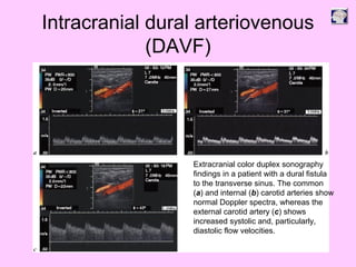 Intracranial dural arteriovenous
(DAVF)
Extracranial color duplex sonography
findings in a patient with a dural fistula
to the transverse sinus. The common
(a) and internal (b) carotid arteries show
normal Doppler spectra, whereas the
external carotid artery (c) shows
increased systolic and, particularly,
diastolic flow velocities.
 