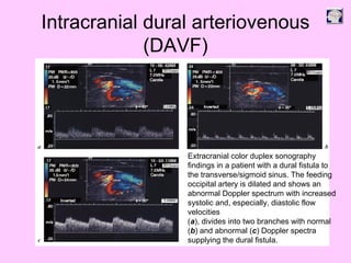 Intracranial dural arteriovenous
(DAVF)
Extracranial color duplex sonography
findings in a patient with a dural fistula to
the transverse/sigmoid sinus. The feeding
occipital artery is dilated and shows an
abnormal Doppler spectrum with increased
systolic and, especially, diastolic flow
velocities
(a), divides into two branches with normal
(b) and abnormal (c) Doppler spectra
supplying the dural fistula.
 