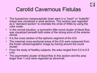 Carotid Cavernous Fistulas
• The hypoechoic mesencephalic brain stem in a “heart” or “butterfly”
shape was visualized in axial sections. This section was regarded
as a “standard section” to orientate the circle of Willis by using the
color mode.
• In the normal situation, a symmetric little round cluster of blood flow
was visualized beneath both sides of the strong echo of the anterior
clinoid.
• It is the cross section of the siphonic segment of the ICA
• The maximal cross-sectional areas of the ICA were measured from
the frozen ultrasonographic image by tracing around the round
cluster.
• From the study of healthy subjects, the area ranged from 0.2 to 0.5
cm2.
• The asymmetric cluster of blood flow in this section and the area
larger than 1 cm2 were regarded as abnormal.
 
