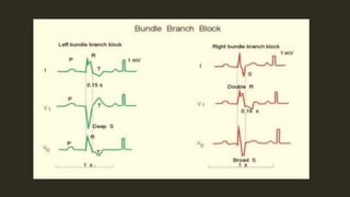 Bundle Branch Block | PPTX