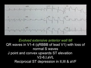 Evolved extensive anterior wall MI
QR waves in V1-4 (qRBBB of lead V1) with loss of
normal S waves
J point and convex upwards ST elevation
V2-6,I,aVL
Reciprocal ST depression in II,III & aVF
 