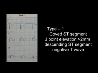 Type – 1
Coved ST segment
J point elevation >2mm
descending ST segment
negative T wave
 