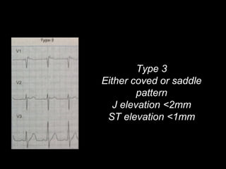 Type 3
Either coved or saddle
pattern
J elevation <2mm
ST elevation <1mm
 