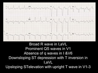 Broad R wave in I,aVL
Prominent QS waves in V1
Absence of q waves in I &V6
Downsloping ST depression with T inversion in
I,aVL
Upsloping STelevation with upright T wave in V1-3
 