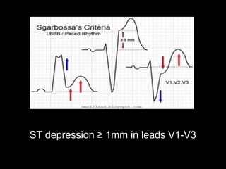 ST depression ≥ 1mm in leads V1-V3
 