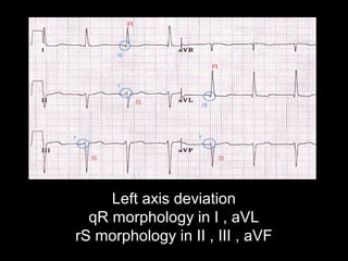 Left axis deviation
qR morphology in I , aVL
rS morphology in II , III , aVF
 