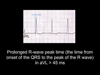 Prolonged R-wave peak time (the time from
onset of the QRS to the peak of the R wave)
in aVL > 45 ms
 