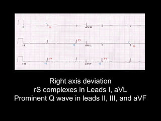Right axis deviation
rS complexes in Leads I, aVL
Prominent Q wave in leads II, III, and aVF
Prominent Q waves in II , III , aVF
 
